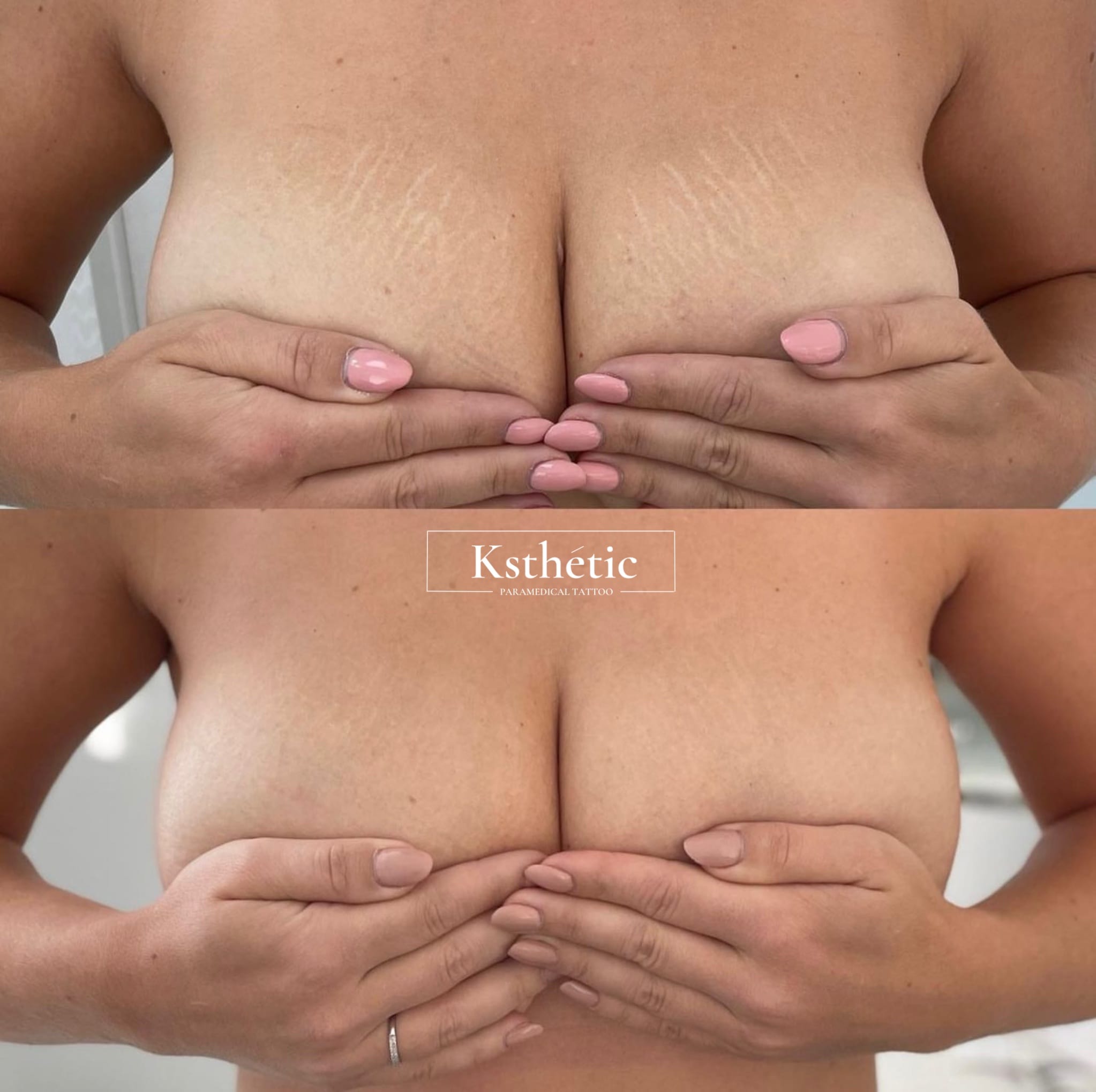 Stretch mark camouflage Stretch mark camouflage