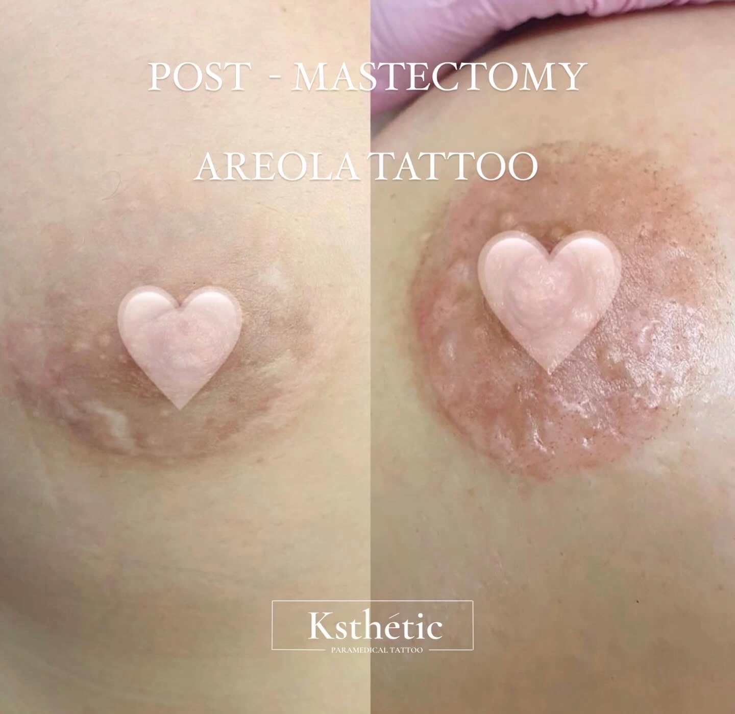 Areola Camouflage Areola Camouflage