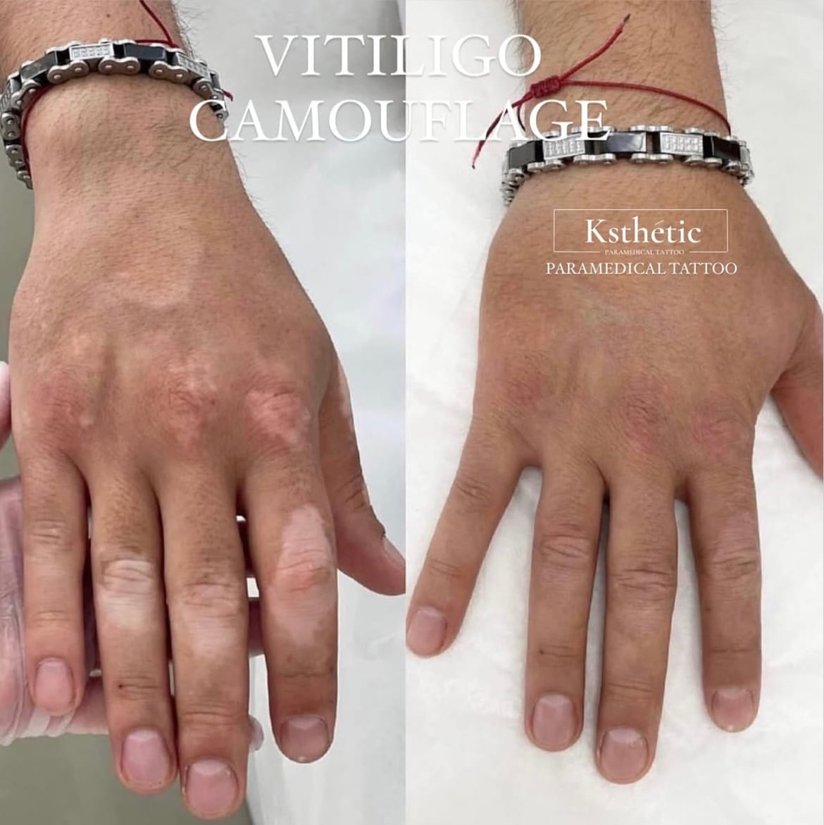 Vitiligo Spot Camouflage Vitiligo Spot Camouflage