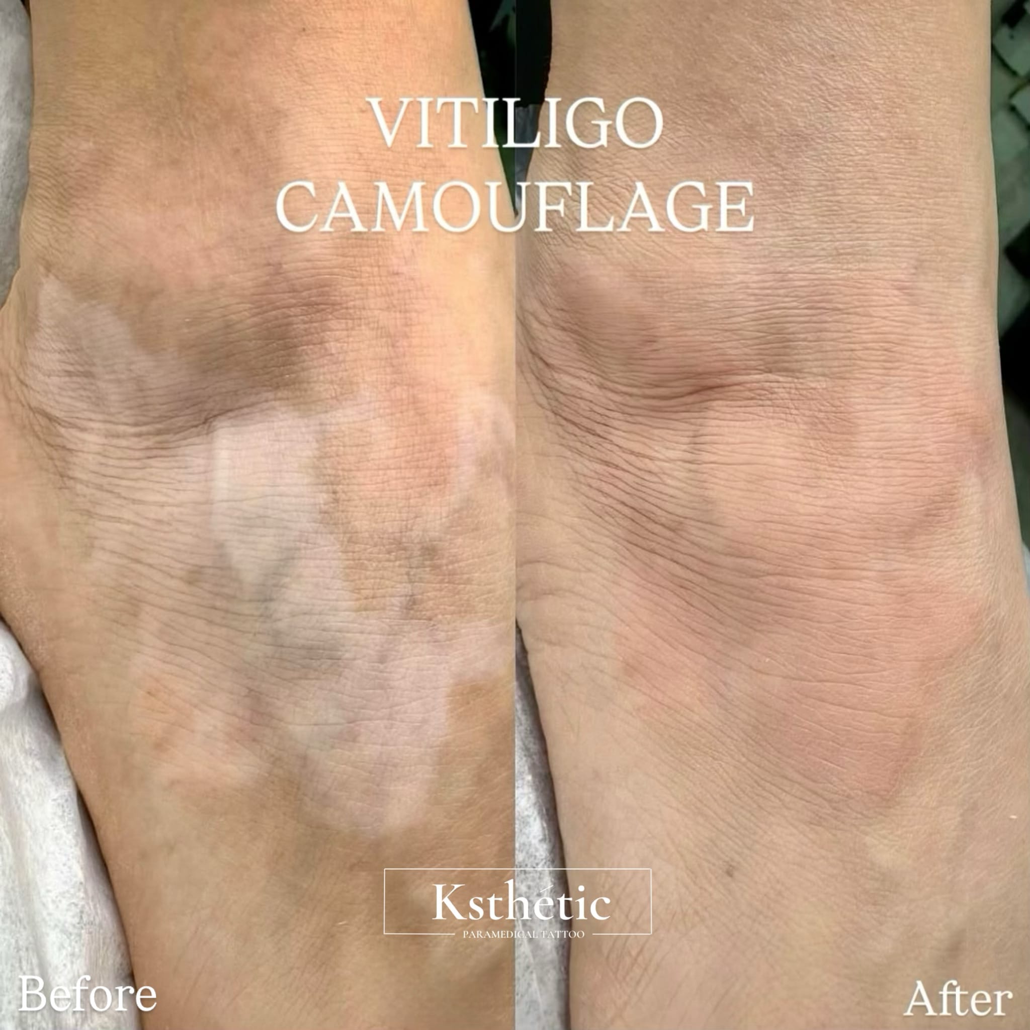 Vitiligo Spot Camouflage Vitiligo Spot Camouflage