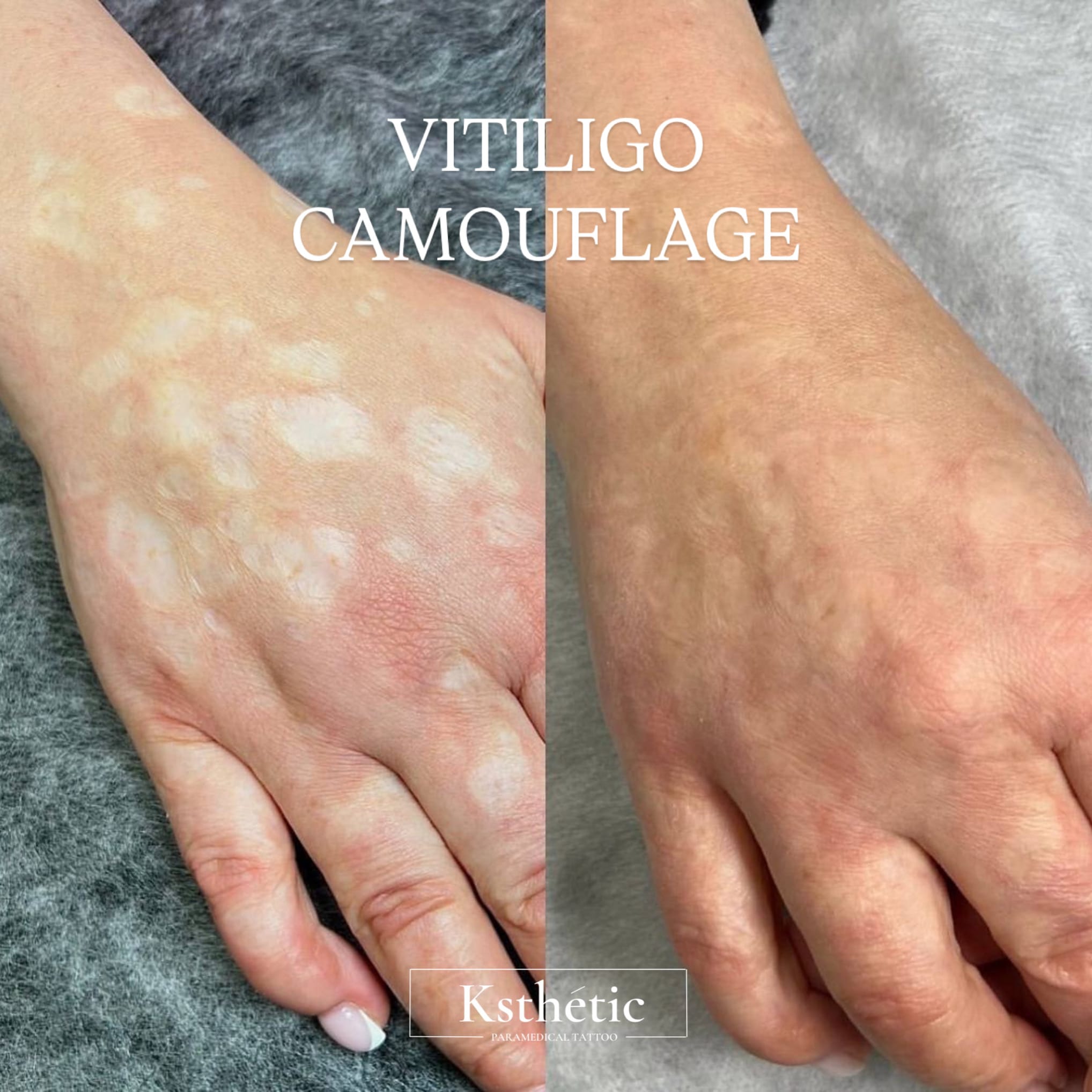 Vitiligo Spot Camouflage Vitiligo Spot Camouflage