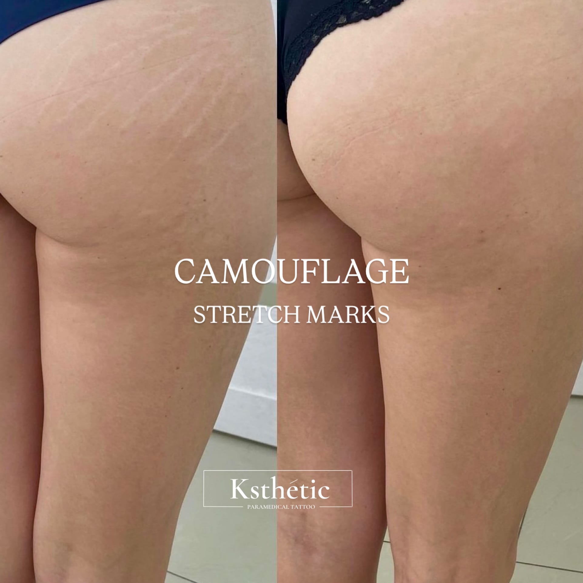 Stretch mark camouflage Stretch mark camouflage