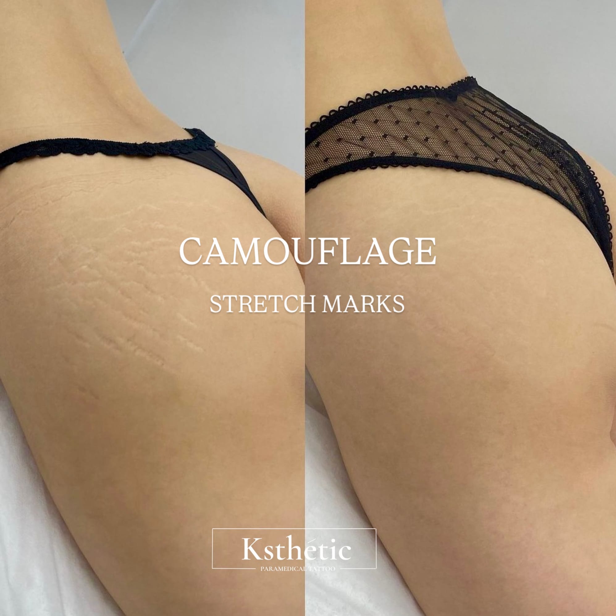 Stretch mark camouflage Stretch mark camouflage