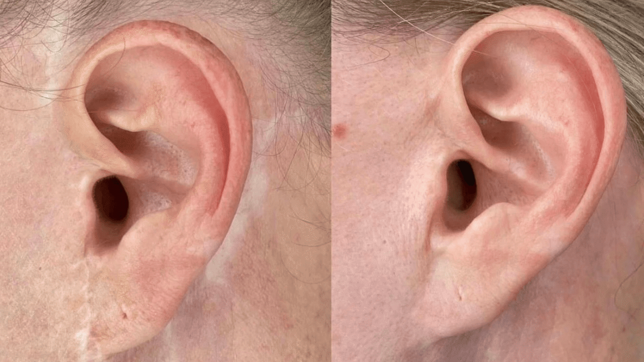 Scar Camouflage Scar Camouflage