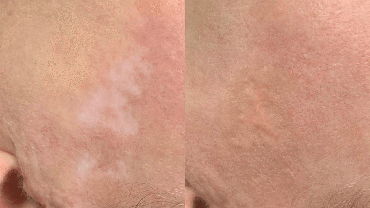 Scar Camouflage Scar Camouflage