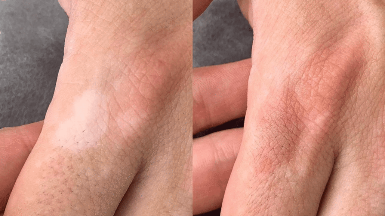 Scar Camouflage Scar Camouflage