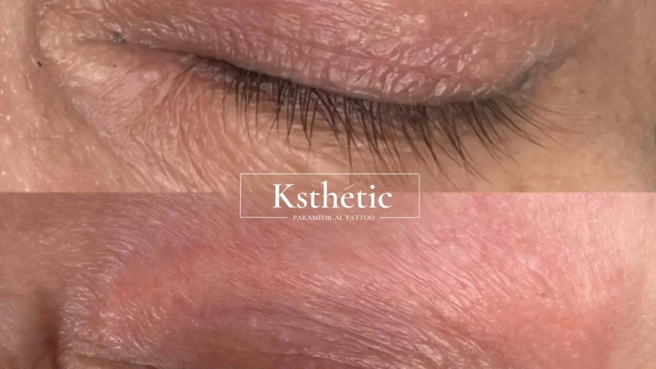 Scar Camouflage Scar Camouflage