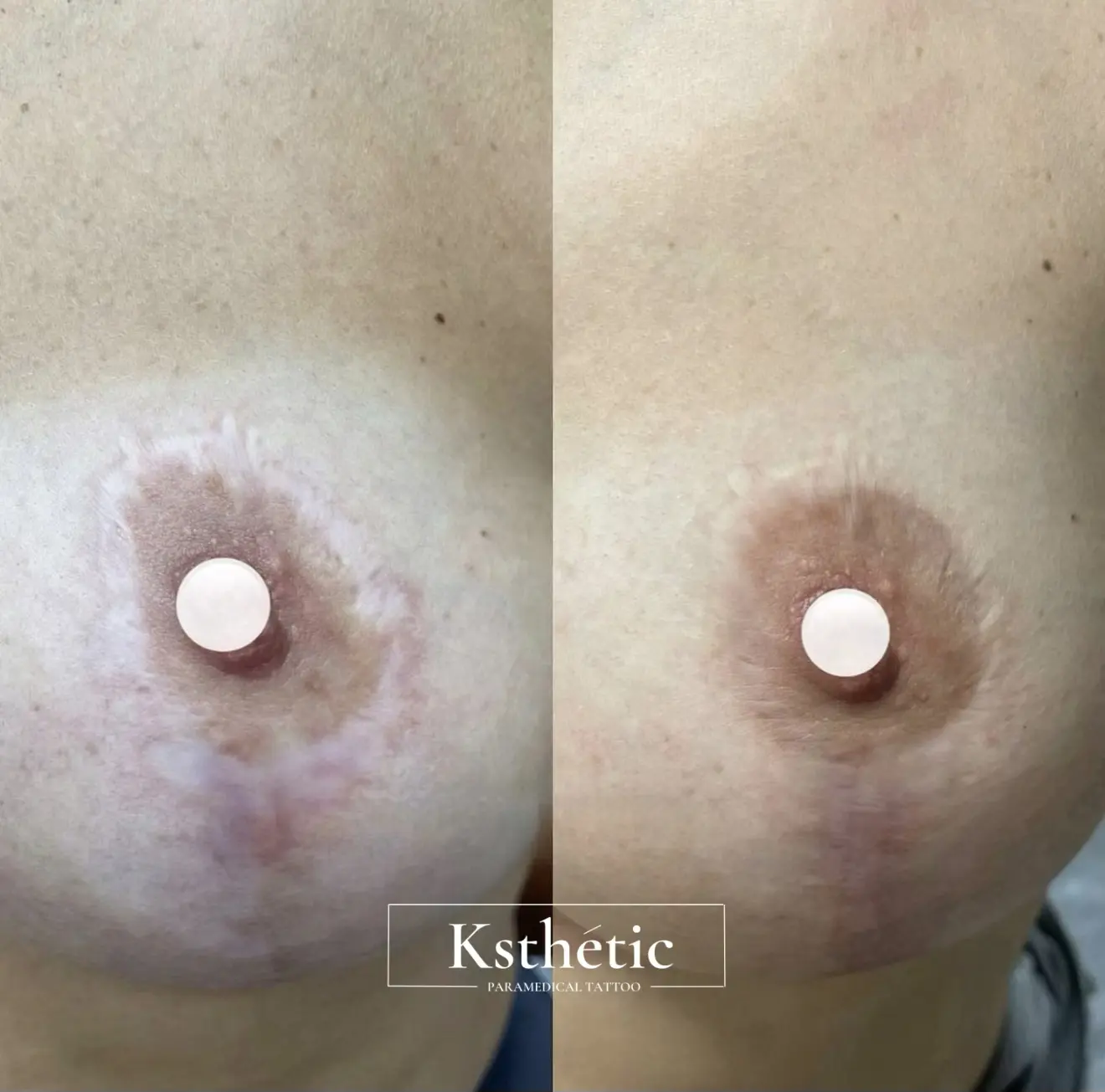 Areola Camouflage Areola Camouflage