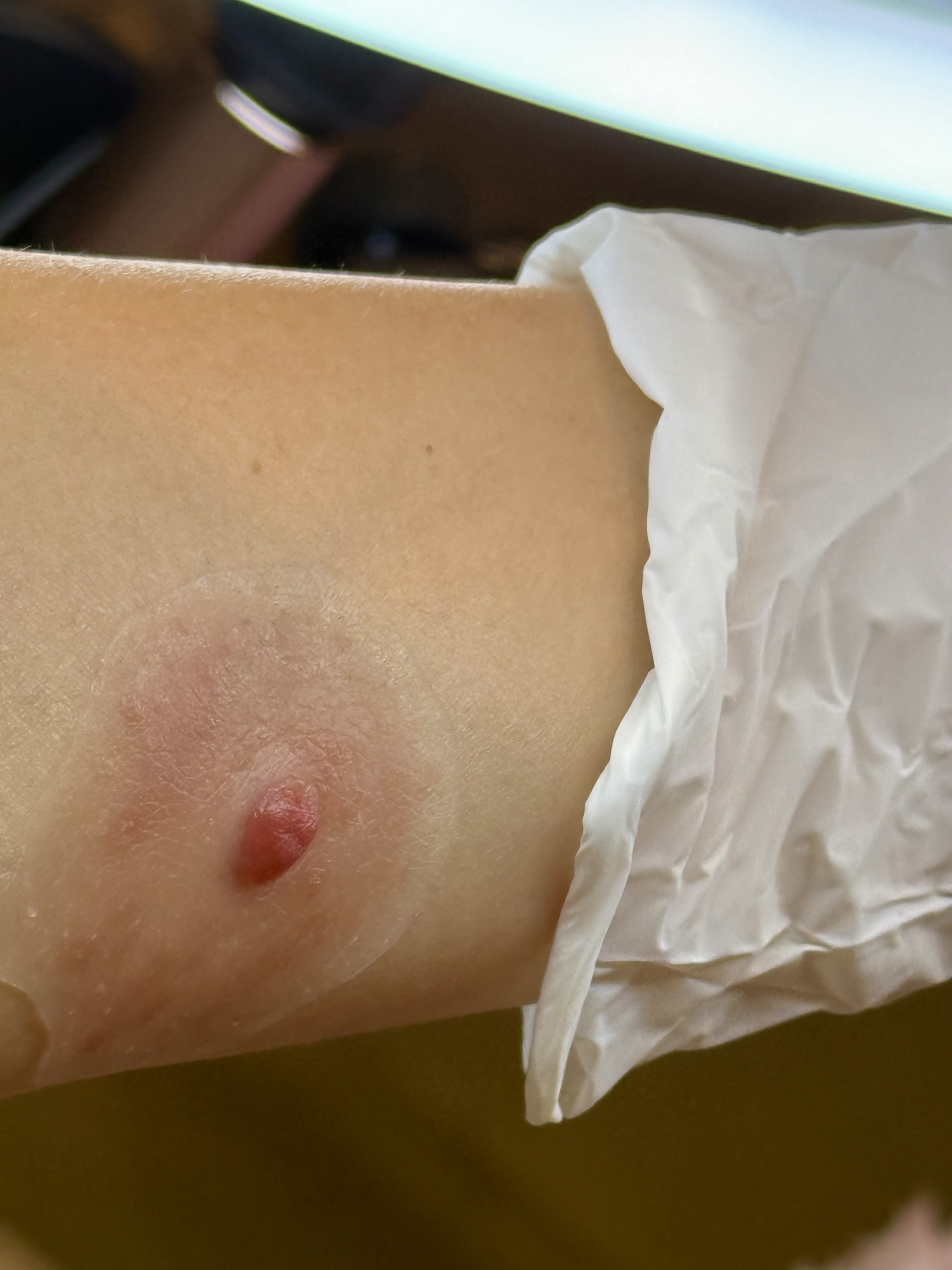 Custom areola prosthesis process