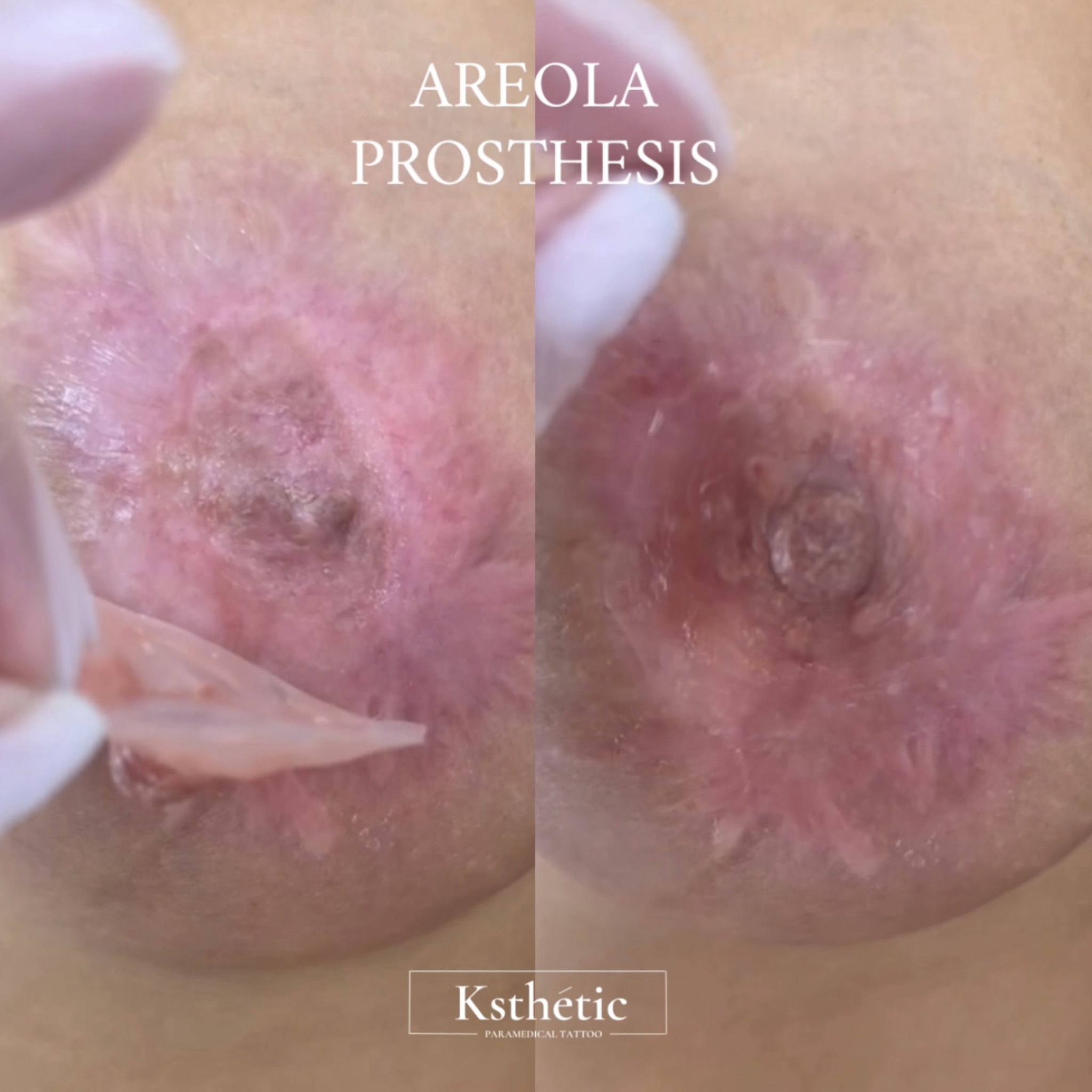 Custom areola prosthesis result
