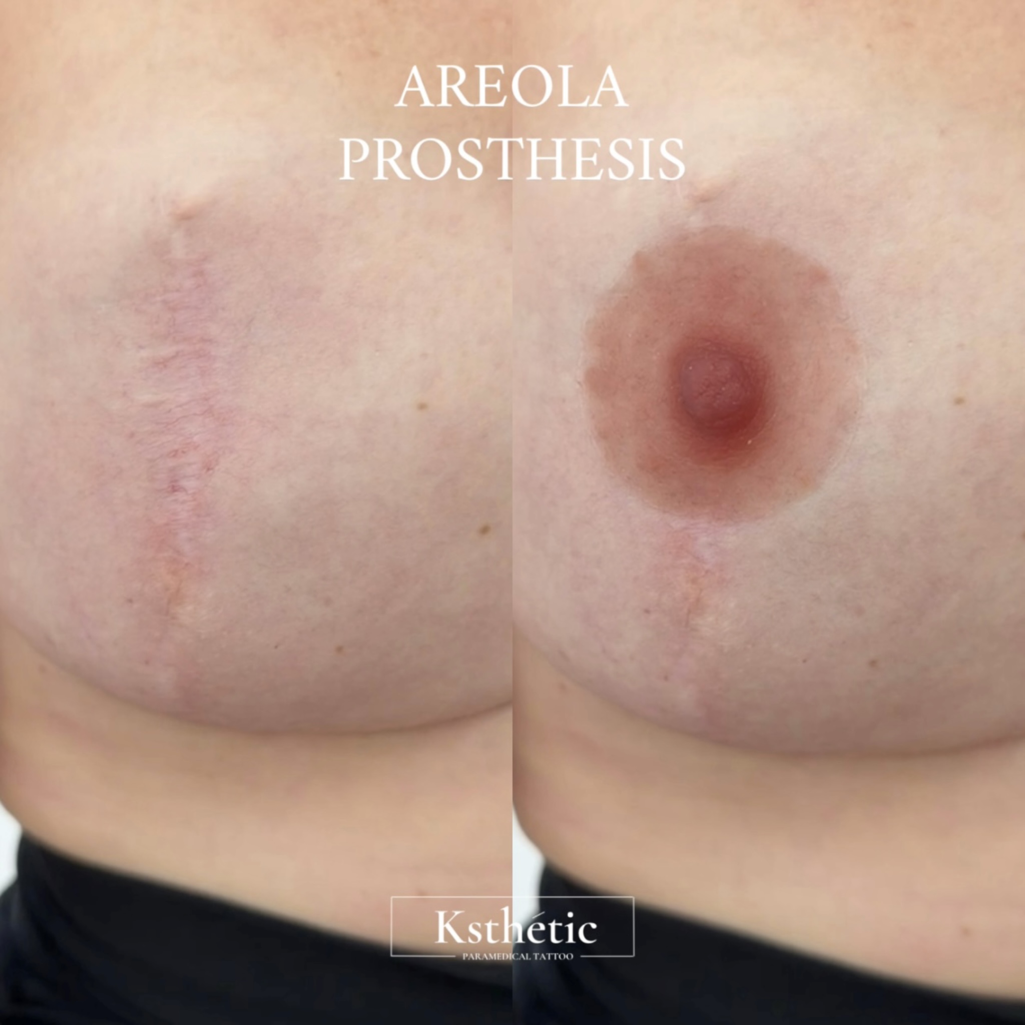 Custom areola prosthesis result