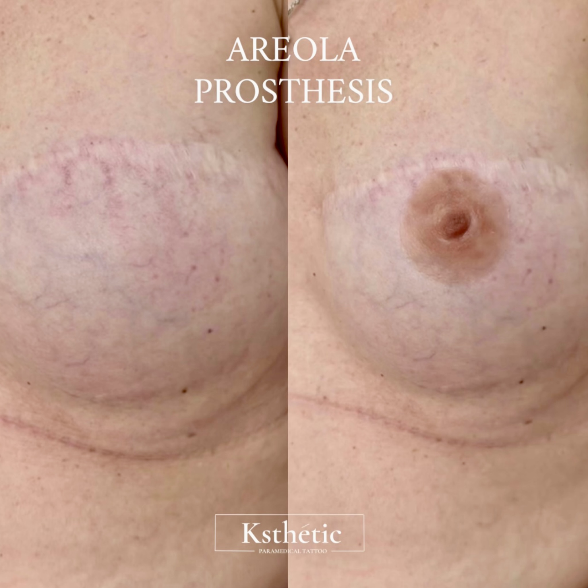 Custom areola prosthesis result