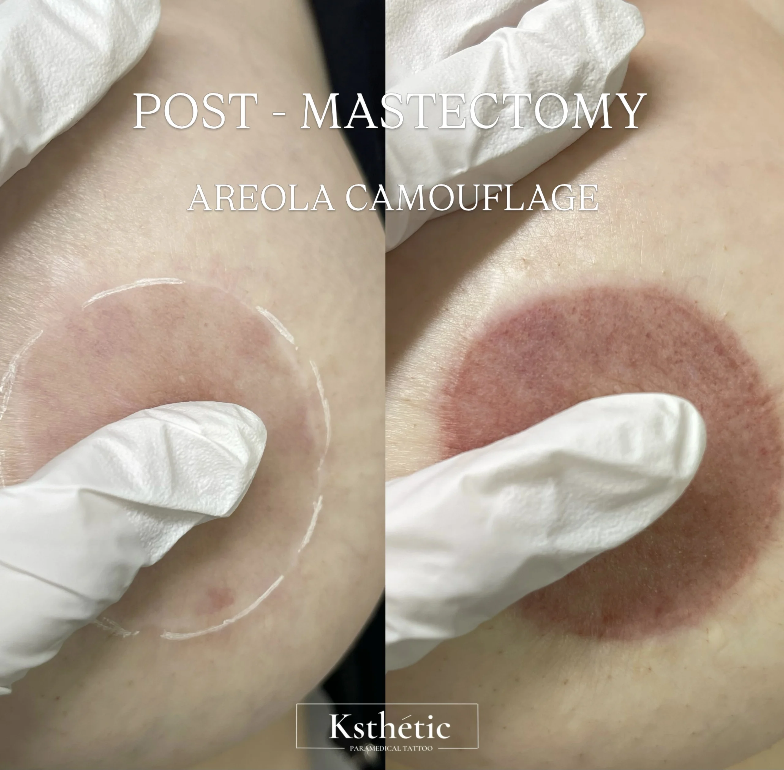Areola camouflage result