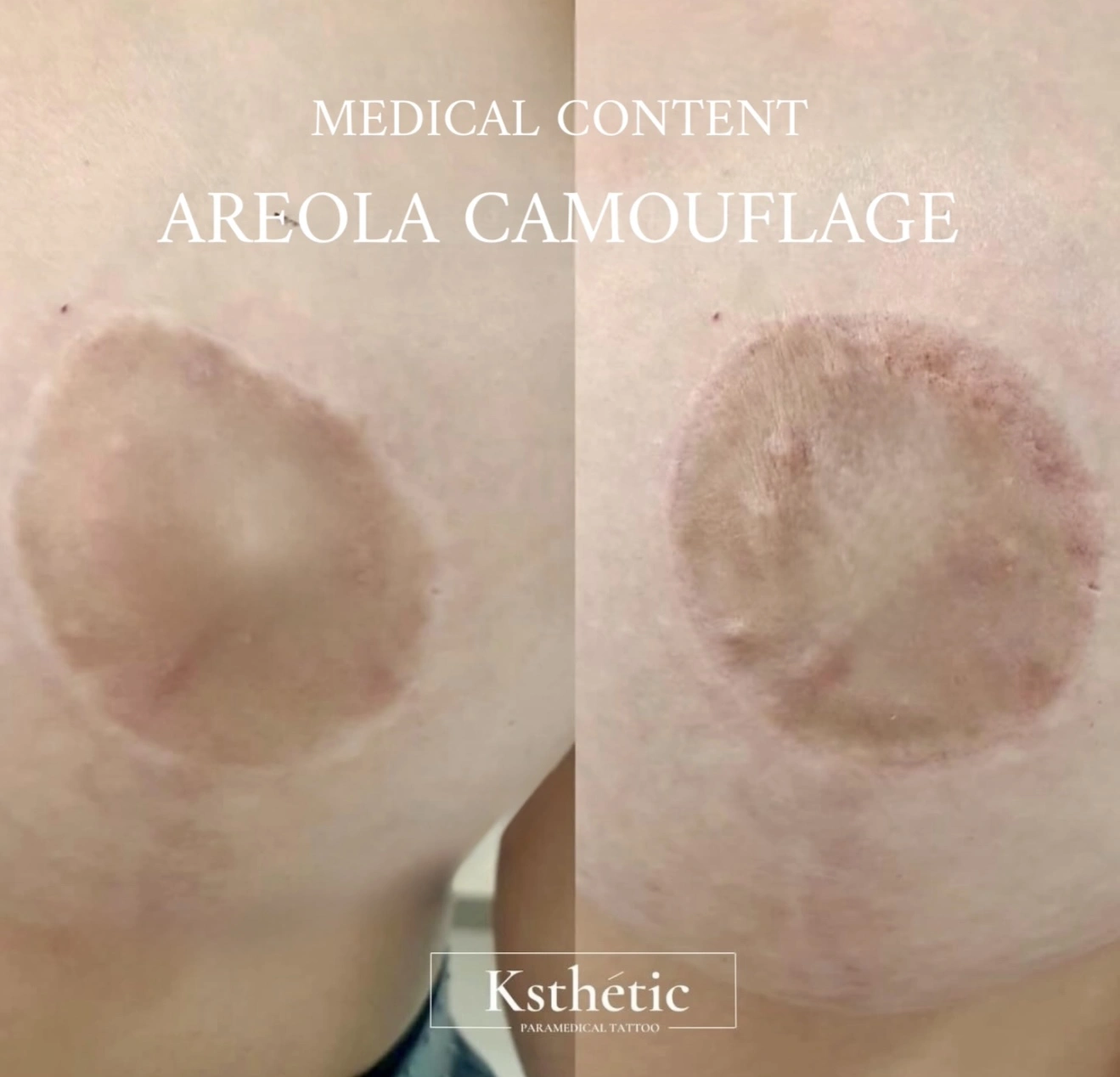 Areola camouflage result