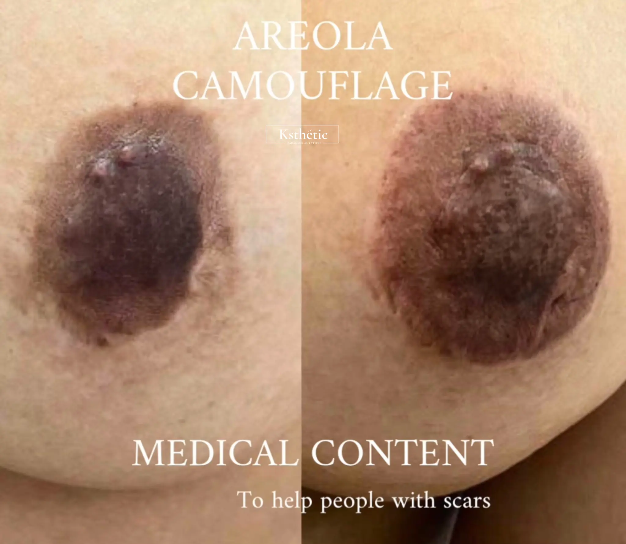 Areola camouflage result