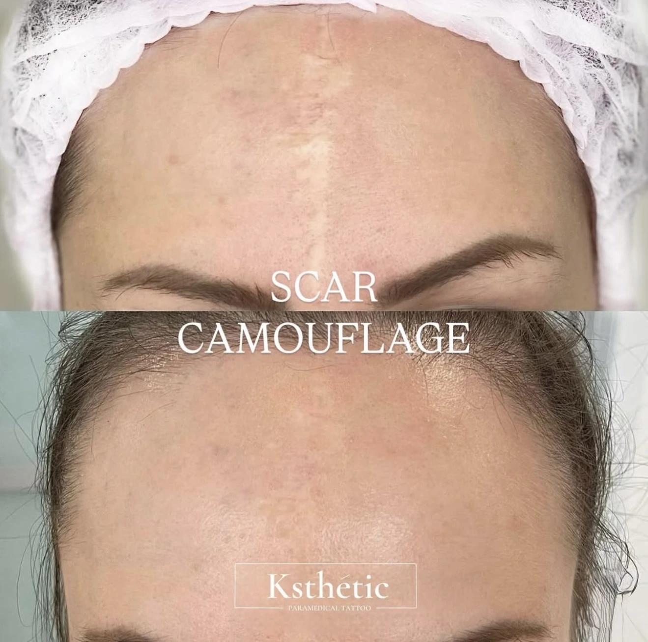Scar camouflage treatment process