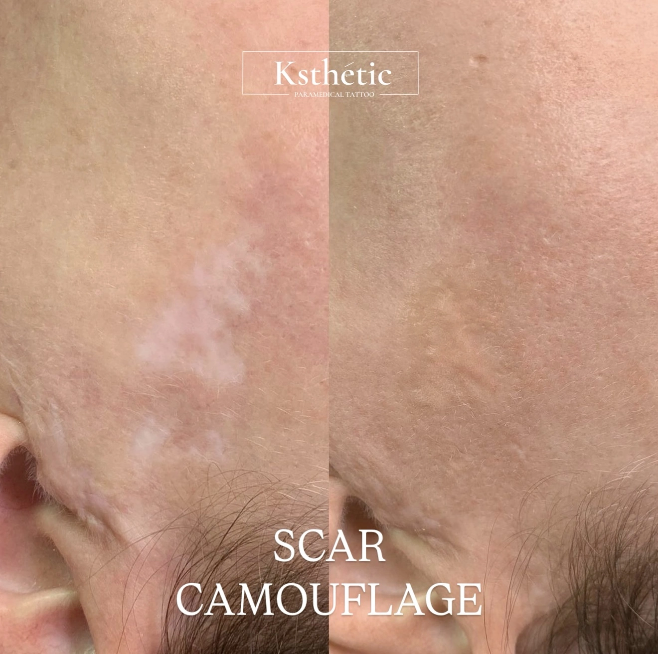 Scar camouflage result