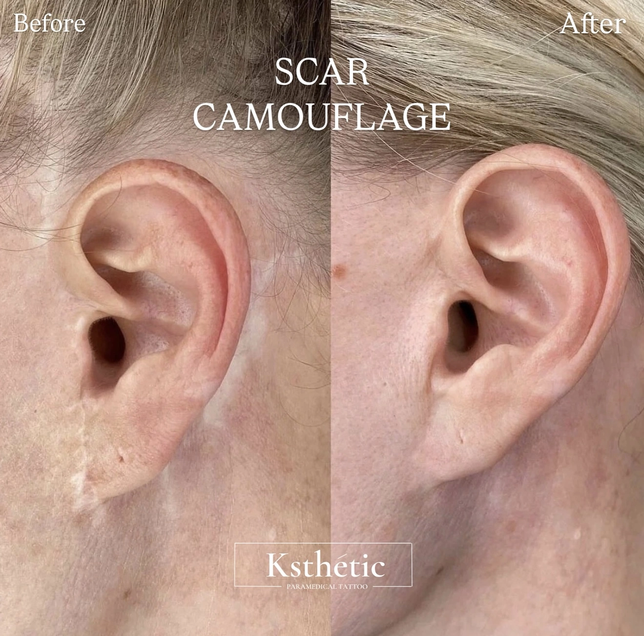 Scar camouflage result