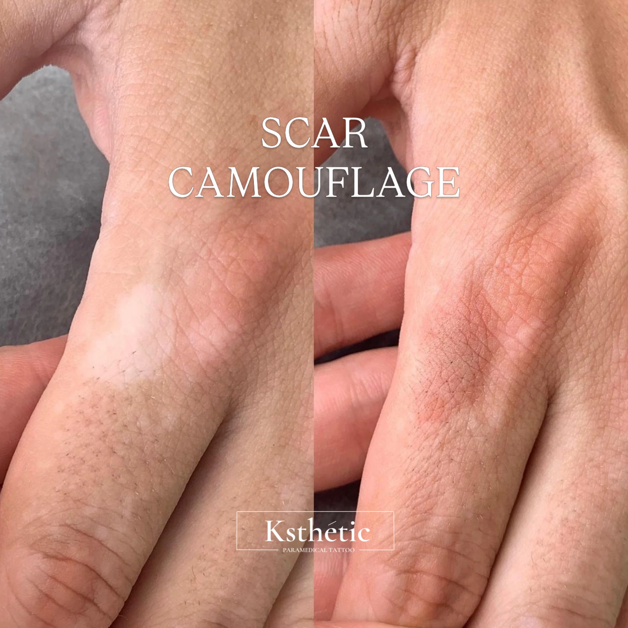 Scar camouflage result
