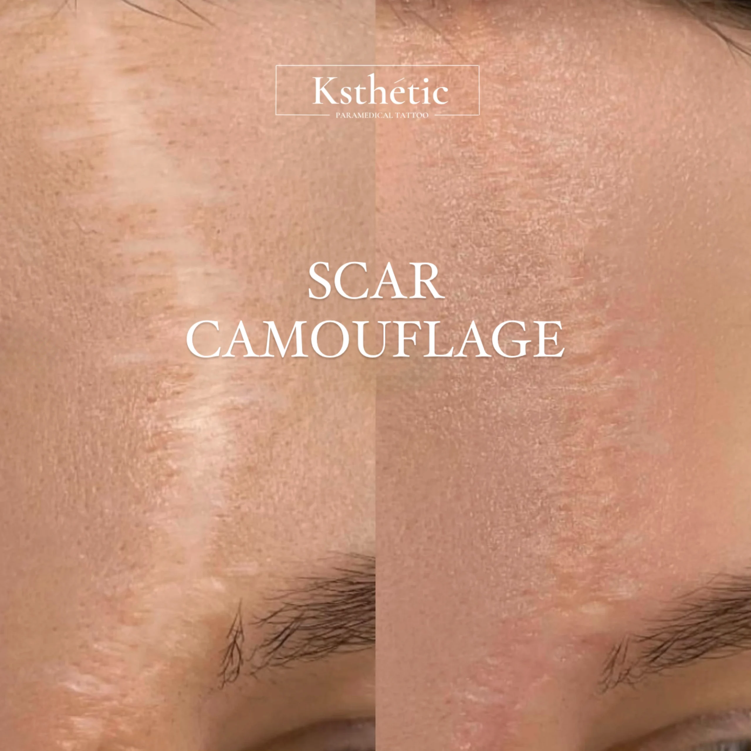 Scar camouflage result