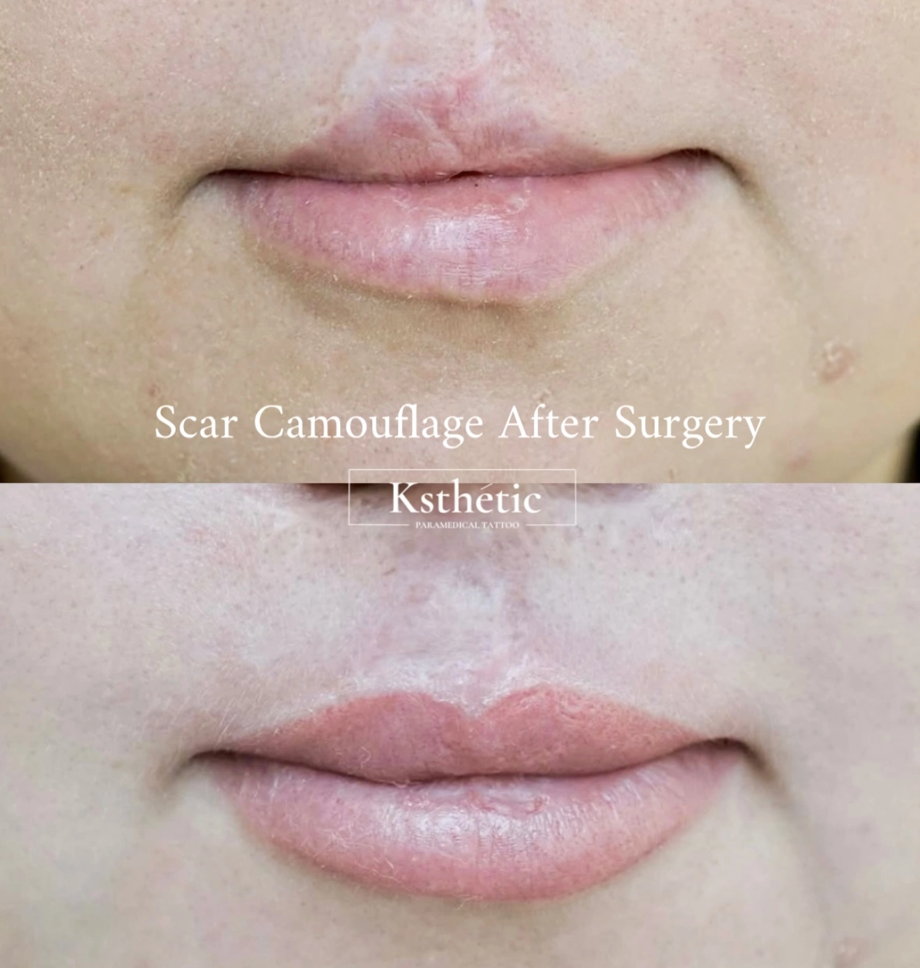 Scar camouflage result